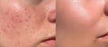 Teatree Acne Serum